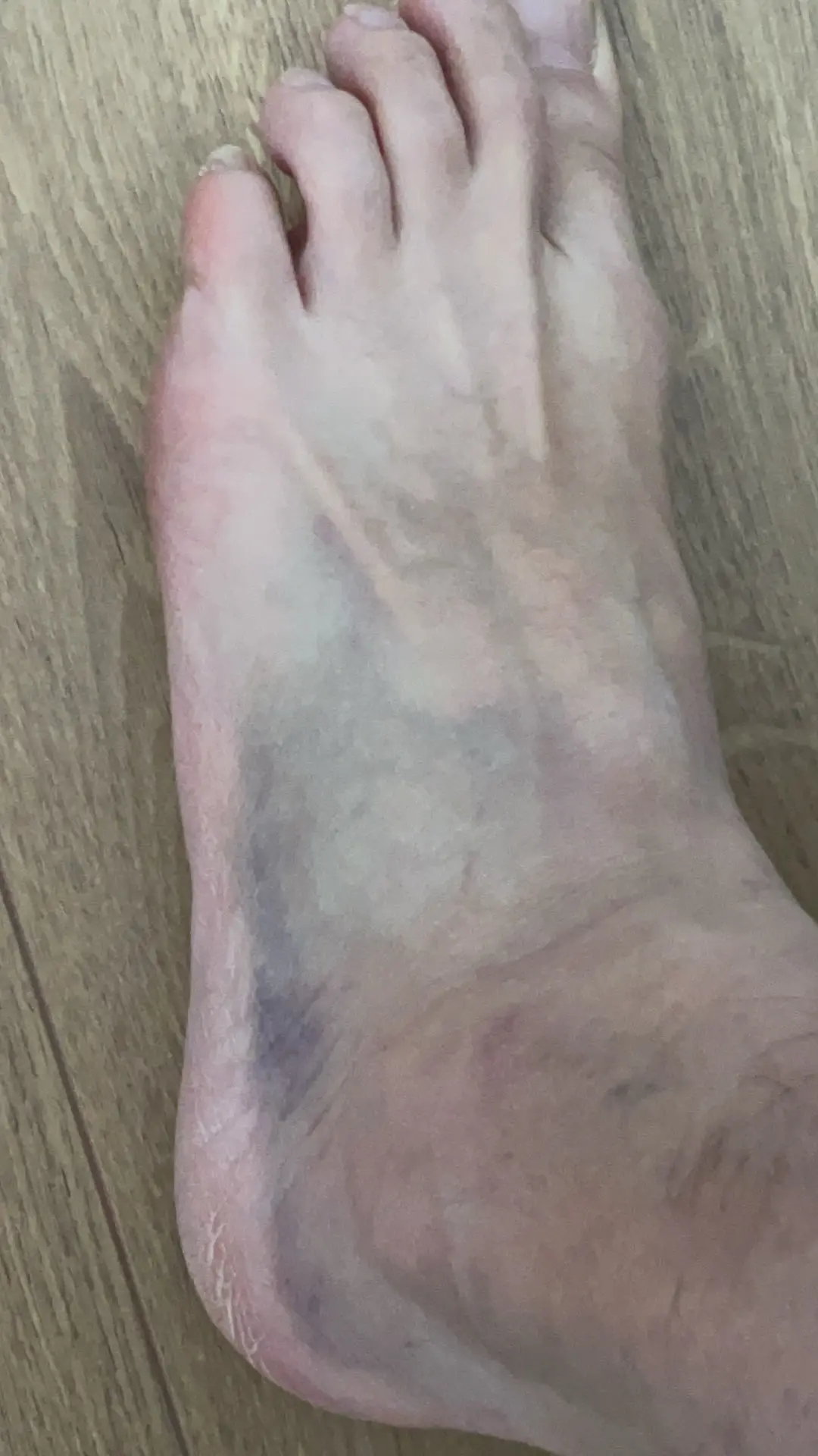 Foto de un tobillo vendado por esguince tras una caída accidental